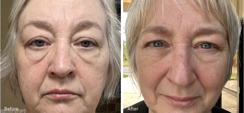 A before and after Real Result of a woman’s face.