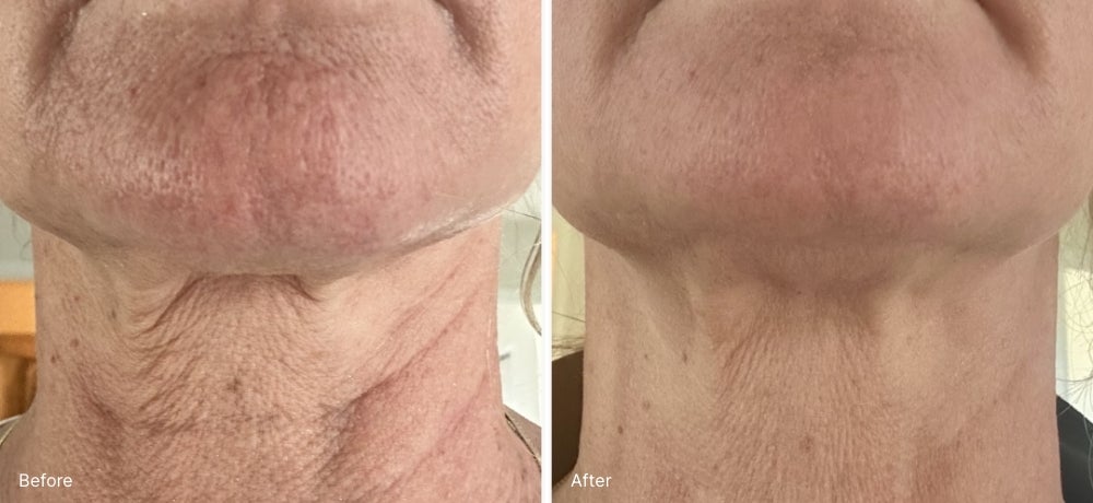 A before and after Real Result of a person’s neck.