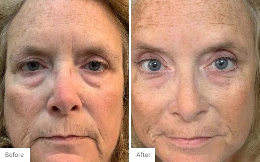 4 - Before and After Real Results photo of a woman's face.