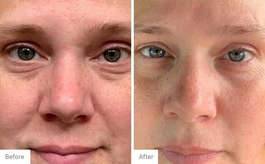 6 - Before and After Real Results photo of a woman's face.