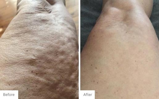 1 - Before and After Real Results photo of someone's leg.