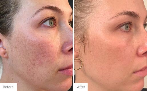 4 - Before and After Real Results photo of a woman's face.