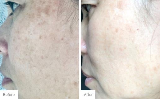 5 - Before and After Real Results photo of a woman's face.