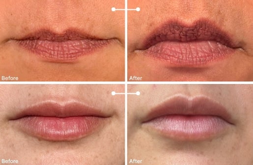 A before and after real result of a woman’s lips after using the Neo-FILLER Volumizing Lip Treatment 
