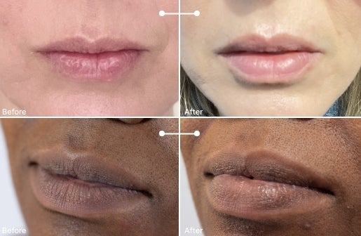 A before and after real result of a woman’s lips after using the Neo-FILLER Volumizing Lip Treatment 