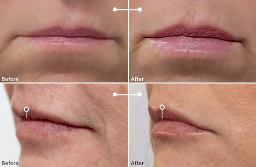 A before and after real result of a woman’s lips after using the Neo-FILLER Volumizing Lip Treatment 