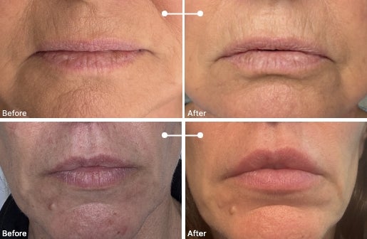 A before and after real result of a woman’s lips after using the Neo-FILLER Volumizing Lip Treatment 