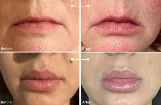 A before and after real result of a woman’s lips after using the Neo-FILLER Volumizing Lip Treatment 