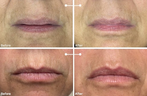 A before and after real result of a woman’s lips after using the Neo-FILLER Volumizing Lip Treatment 