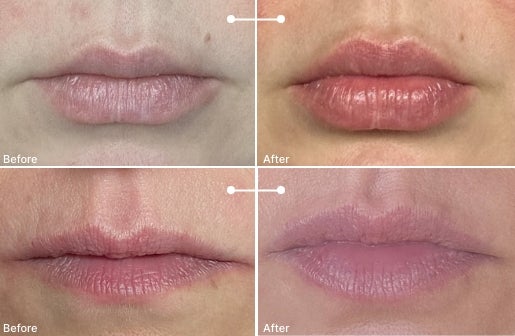 A before and after real result of a woman’s lips after using the Neo-FILLER Volumizing Lip Treatment 