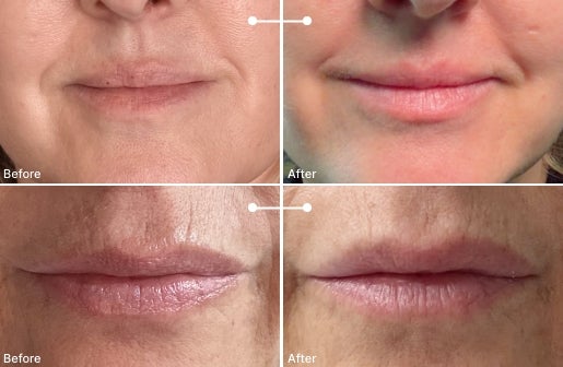 A before and after real result of a woman’s lips after using the Neo-FILLER Volumizing Lip Treatment 