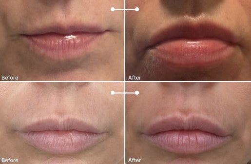 A before and after real result of a woman’s lips after using the Neo-FILLER Volumizing Lip Treatment 