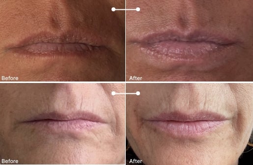A before and after real result of a woman’s lips after using the Neo-FILLER Volumizing Lip Treatment 