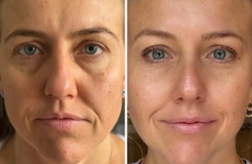 A before and after real result of a woman’s face after using the Neo-FILLER Face & Lip Contour Duo.