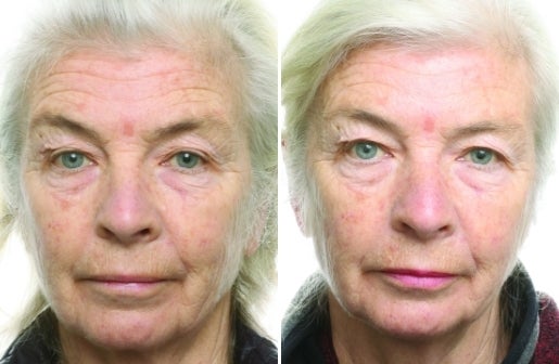 A before and after real result of a woman’s face after using the Neo-FILLER Face & Lip Contour Duo.