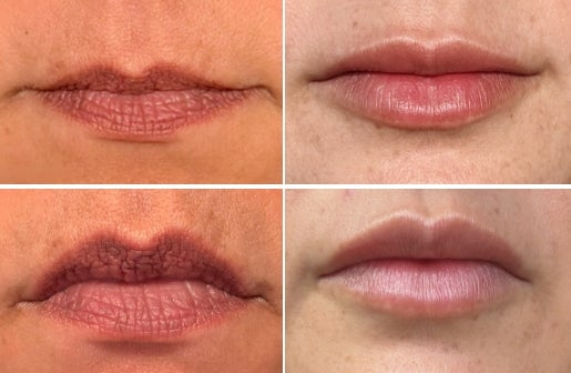 A before and after real result of a woman’s lips area after using the Neo-FILLER Face & Lip Contour Duo.