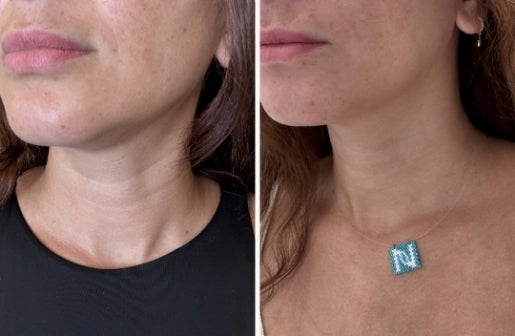 A before and after real result of a woman’s décolletage area after using the Neo-FILLER Face & Lip Contour Duo.