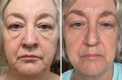 A before and after real result of a woman’s face after using the Neo-FILLER Face & Lip Contour Duo.