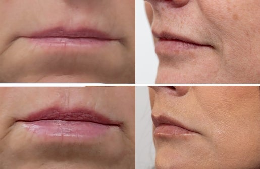 A before and after real result of a woman’s lips area after using the Neo-FILLER Face & Lip Contour Duo.
