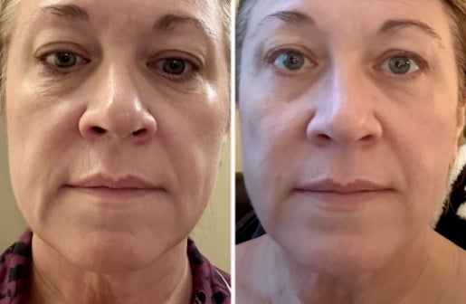 A before and after real result of a woman’s face after using the Neo-FILLER Face & Lip Contour Duo.