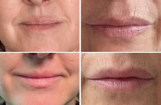 A before and after real result of a woman’s lips area after using the Neo-FILLER Face & Lip Contour Duo.