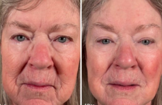 A before and after real result of a woman’s face after using the Neo-FILLER Face & Lip Contour Duo.