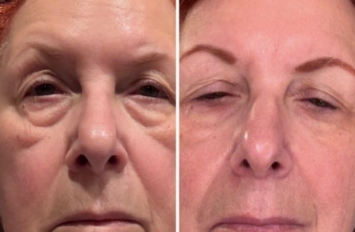 A before and after real result of a woman’s face after using the Neo-FILLER Face & Lip Contour Duo.