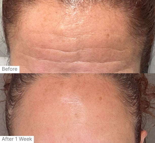A before and after real result of a person's forehead after using Neo-FILLER.