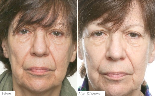 A before and after real result of a woman’s cheek area after using Neo-FILLER.