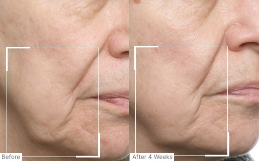 A before and after real result of a woman’s cheek area after using Neo-FILLER.