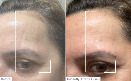 A before and after real result of a woman’s forehead area after using Neo-FILLER.