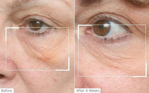A before and after real result of a woman’s under eye area after using Neo-FILLER.