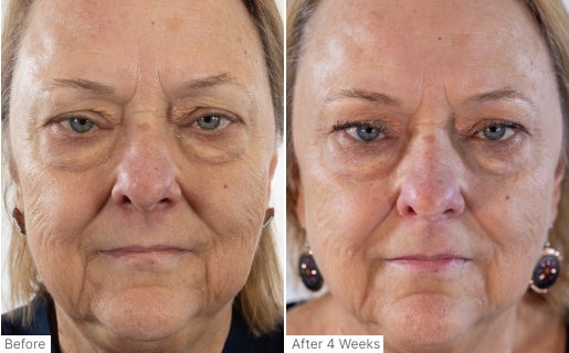 A before and after real result of a woman’s face after using Neo-FILLER.