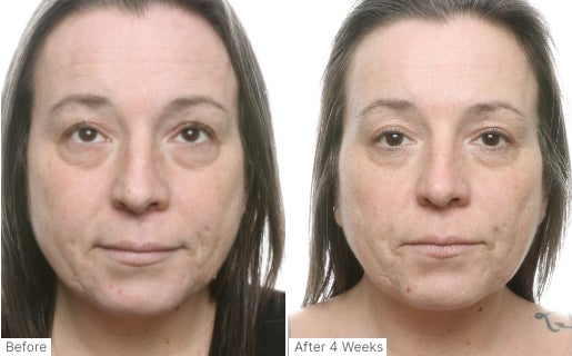 A before and after real result of a woman’s face after using Neo-FILLER.