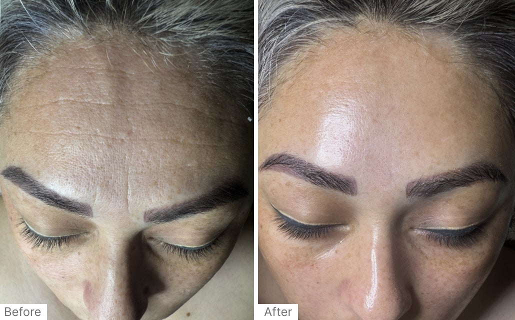 Before and After RealResult of a woman's forehead after using Neo-FILLER.