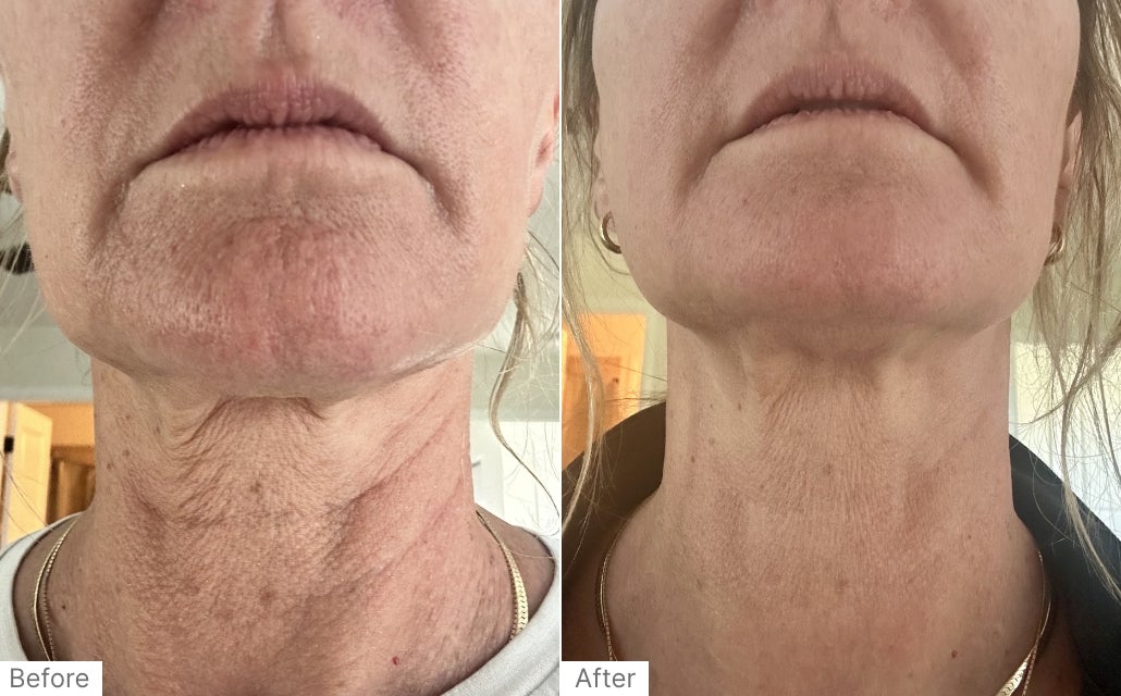 Before and After RealResult of a woman's lower face and neck after using Neo-FILLER.
