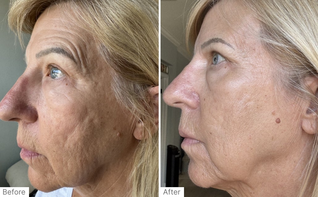 A before and after real result of a woman’s cheek area after using Neo-FILLER and Instant Facial.