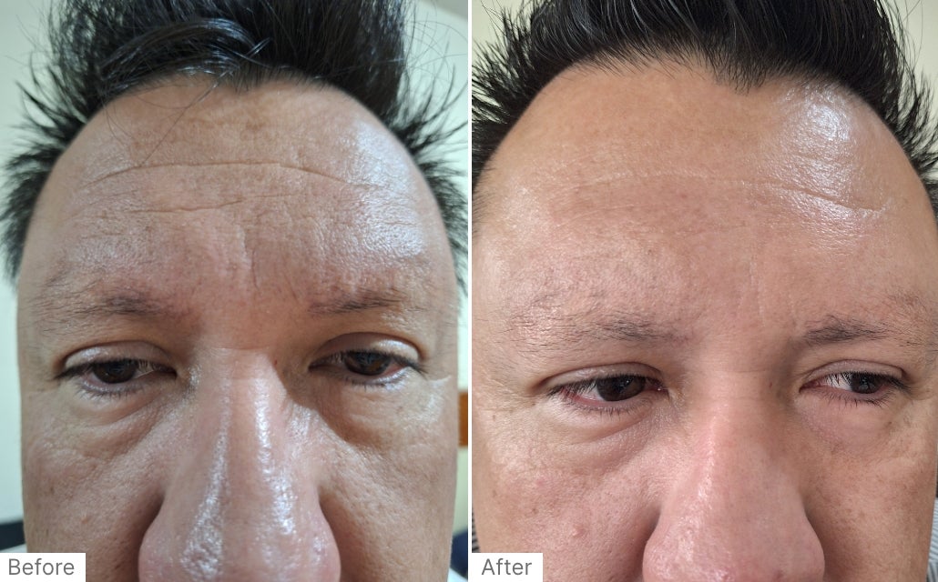 A before and after real result of a woman’s face after using Neo-FILLER and Instant Facial.