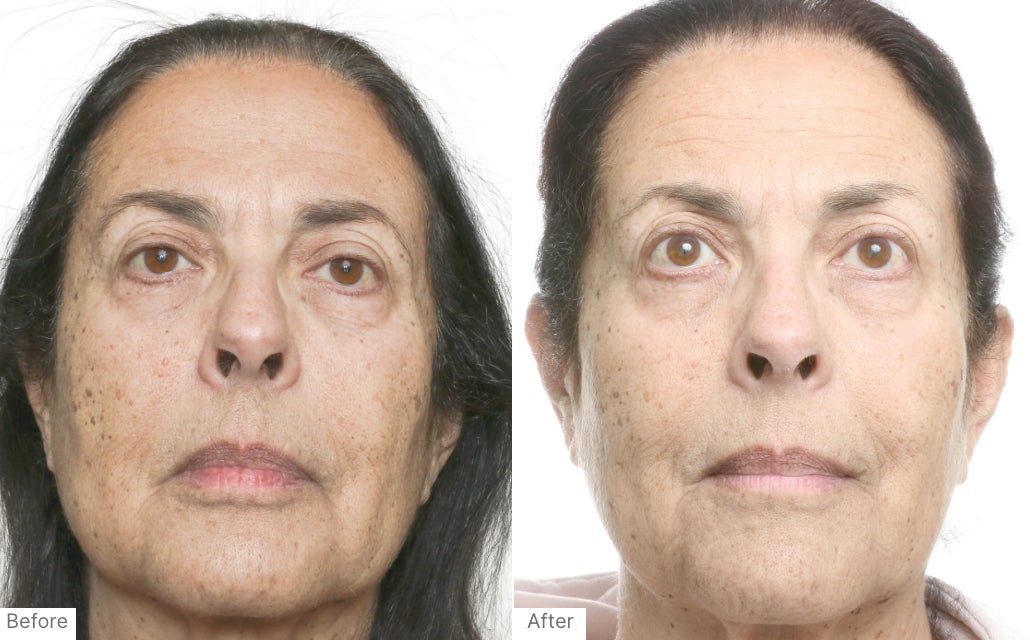 A before and after real result of a woman’s face after using Neo-FILLER and Instant Facial.
