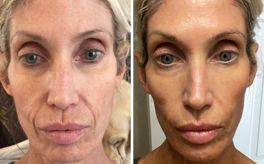 A before and after real result of a woman’s face after using Neo-FILLER.