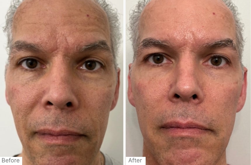 A before and after real result of a woman's lower face after using Neo-FILLER.