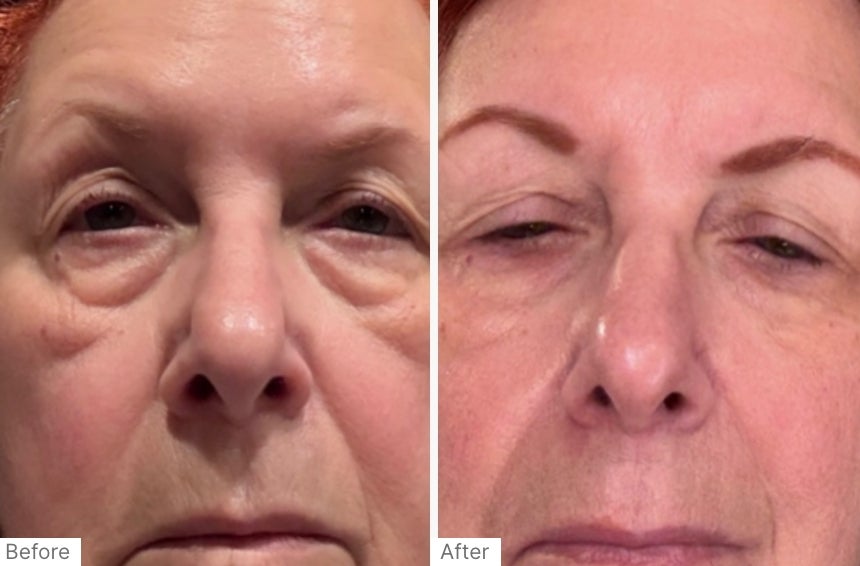 A before and after real result of a woman's face after using Neo-FILLER.