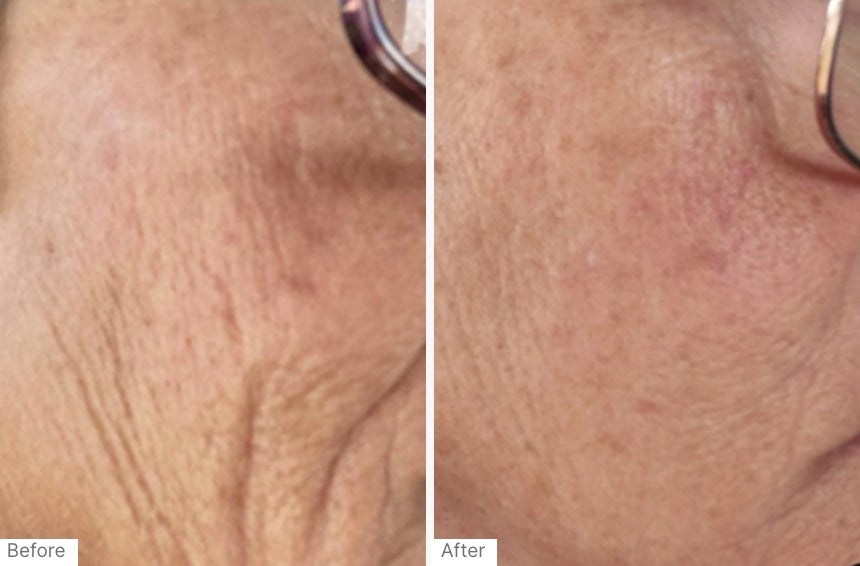 A before and after real result of a person's cheek after using Neo-FILLER.