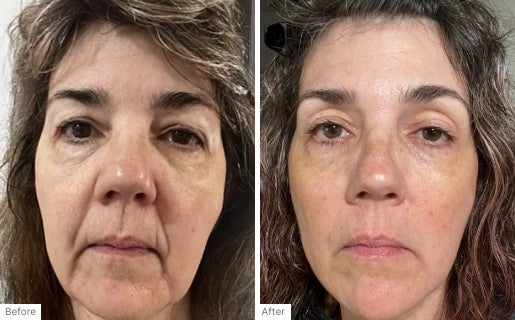 A before and after real result of a woman’s face after using Neo-FILLER.