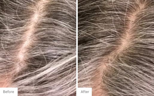 4 - Before and After Real Results picture of a woman's scalp.