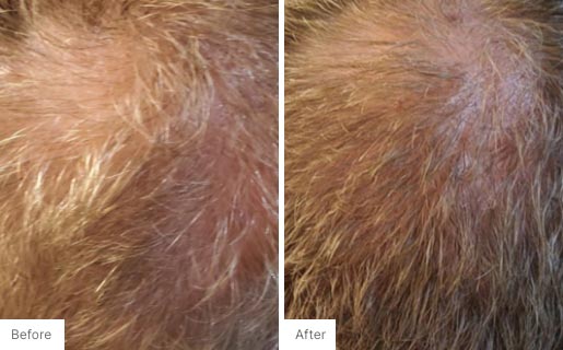 6 - Before and After Real Results picture of a man's scalp.