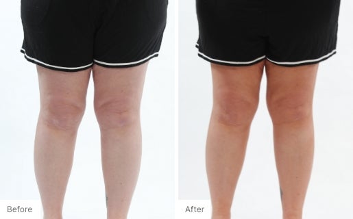 4 - Before and After Real Results of a woman's legs from using the 3-in-1 Self Tanning + Sculpting Foam.