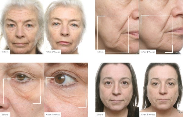 A collage of before and after real results of users after using the Fill, Lift & Glow Set.