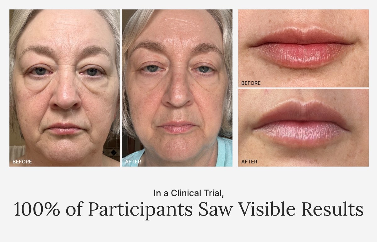 100% of clinical trial participants saw visible results. Featured is a collage of before and after results.