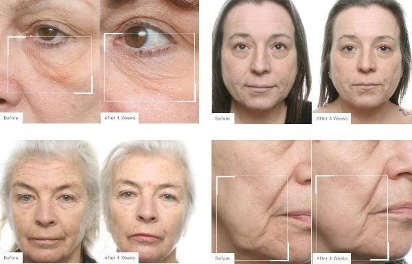 A collage of before and after real results of users that have used Neo-FILLER.